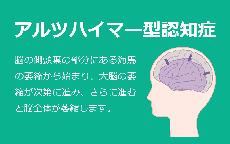 4大認知症：アルツハイマー型認知症