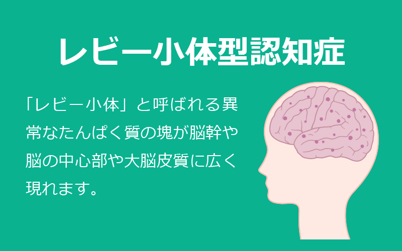 4大認知症：レビー小体型認知症