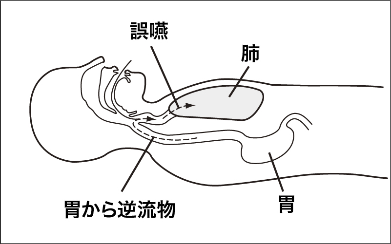 【体位変換】仰臥位・側臥位のポジショニング介護の基本を解説